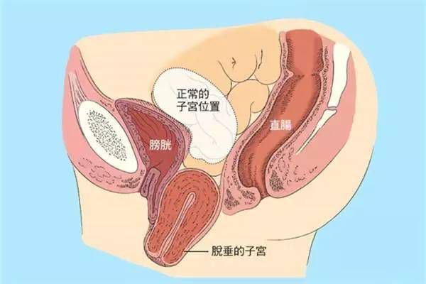 【產(chǎn)后修復(fù)】盆腔臟器脫垂，你有嗎？