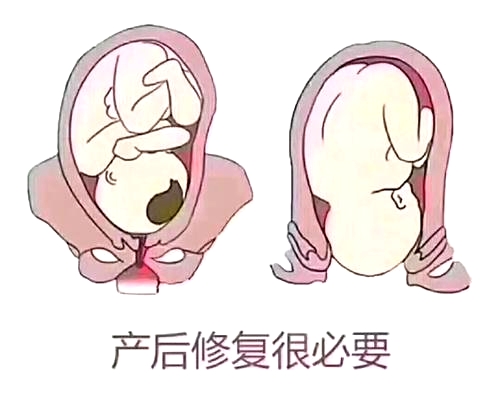 產(chǎn)后恢復(fù)項目好不好，兩大指標(biāo)尤為關(guān)鍵