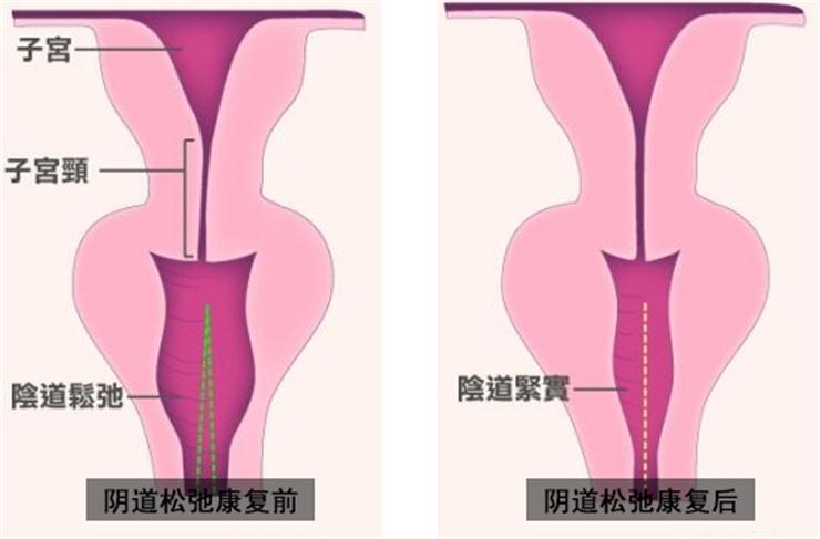 【盆底肌修復(fù)】盆底不修復(fù)，老來后患無窮