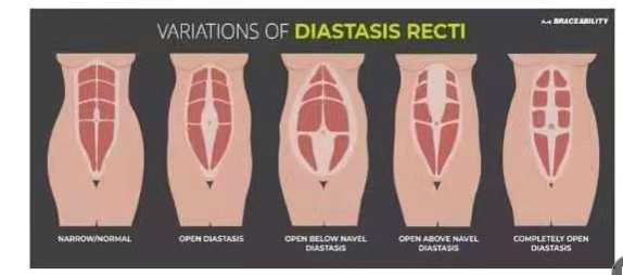 腹直肌分離如何分類？腹直肌分離修復(fù)