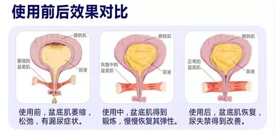 盆底康復(fù)治療怎么做？產(chǎn)后盆底功能檢測很重要