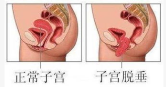 產(chǎn)后恢復，盆底肌修復的功能障礙