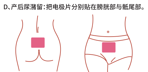 產后康復治療儀治療產后尿潴留臨床效果觀察