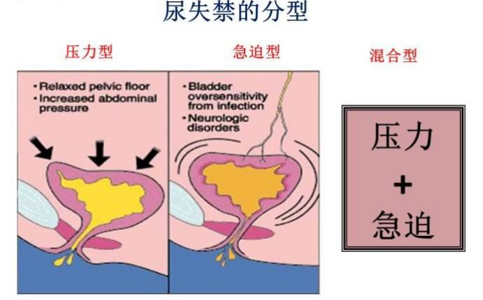 產(chǎn)后盆底肌怎么修復|尿失禁的類型，傻傻分不清