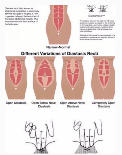 腹直肌分離修復(fù)詳細(xì)解答，精準(zhǔn)評估結(jié)合自我修復(fù)