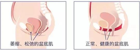 尿失禁治療儀器，不再詢問盆底康復治療有用嗎這類無意義問題