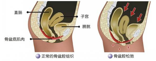 盆底功能檢測(cè)很重要，盆底肌松弛了會(huì)有什么表現(xiàn)呢？