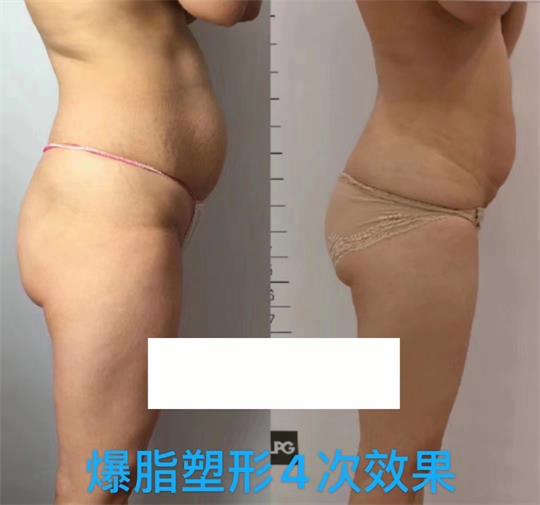 產(chǎn)后塑形美雕儀，生完孩子真的很難恢復(fù)身材？未必……