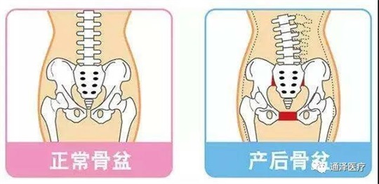 產(chǎn)后康復(fù)儀器能對骨盆產(chǎn)生康復(fù)鞏固作用嗎？答案肯定是可以的