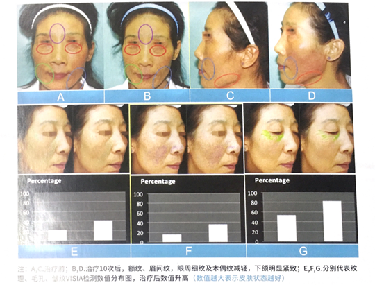 速get8D多極射頻美雕儀，保持年輕體態(tài)的好產(chǎn)品