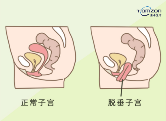 你害怕子宮脫垂嗎？盆底肌修復(fù)儀器來拯救你