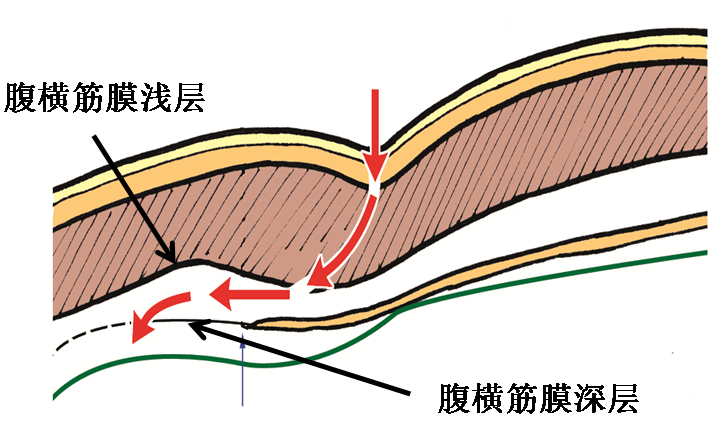 腹直肌修復(fù)