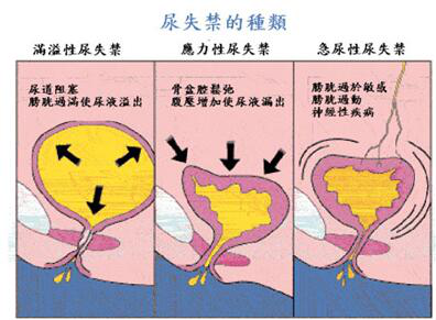 產(chǎn)后盆底肌修復(fù)